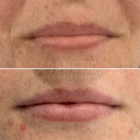 Understanding 1ml Lip Filler Impact